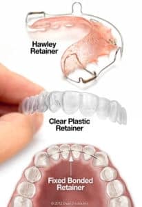 types of orthodontic retainers