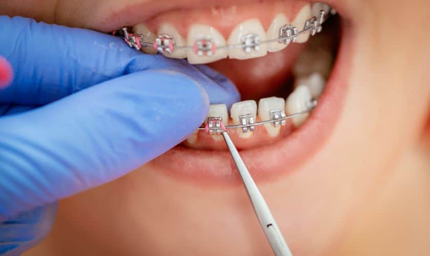 New Year Sparkle: Clear Braces For Radiant Holiday Smile