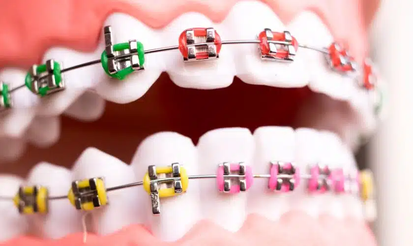 How Braces Can Reduce the Risk of Dental Problems?
