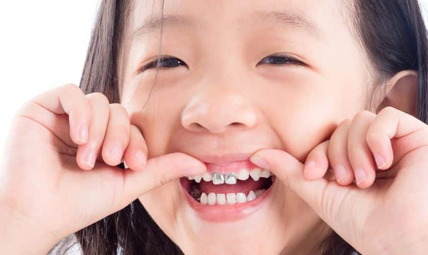 Step-by-Step Guide to Pediatric Dental Sealant Application